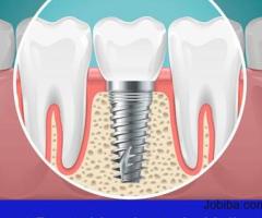 Dental Implant In Kolkata | Best Dental Implant In Kolkata | Dental Implant Treatment In Kolkata